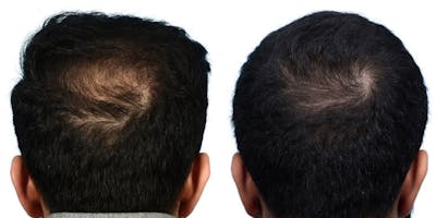 Hair Restoration Before & After Gallery - Patient 382396 - Image 1
