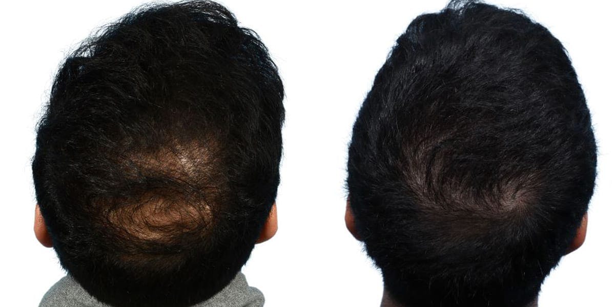 Hair Restoration Before & After Gallery - Patient 382396 - Image 2