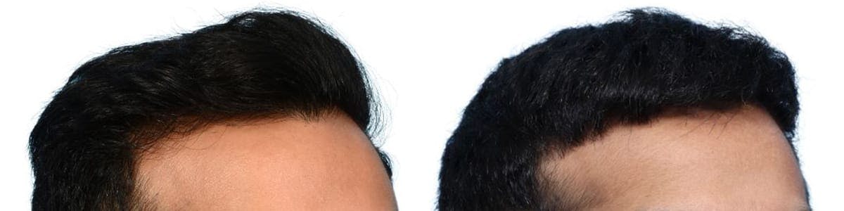 FUE Hair Transplant Before & After Gallery - Patient 750055 - Image 3