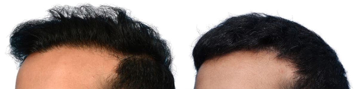 Hair Restoration Before & After Gallery - Patient 382396 - Image 4