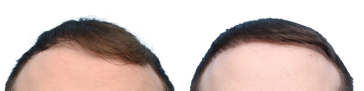 FUE Hair Transplant Before & After Gallery - Patient 772907 - Image 2