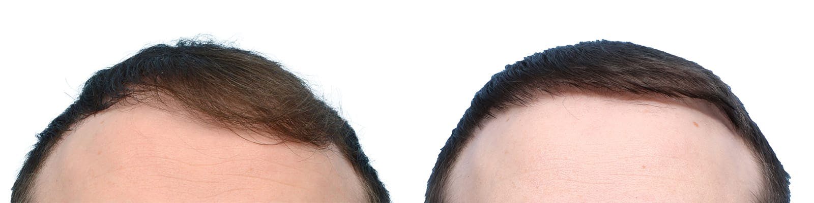 Hair Restoration  Before & After Gallery - Patient 376153 - Image 2