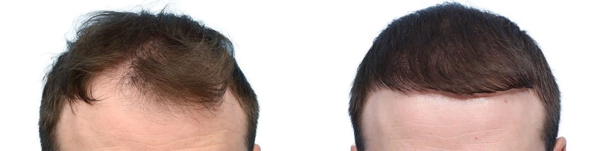 Hair Restoration Before & After Gallery - Patient 376153 - Image 1