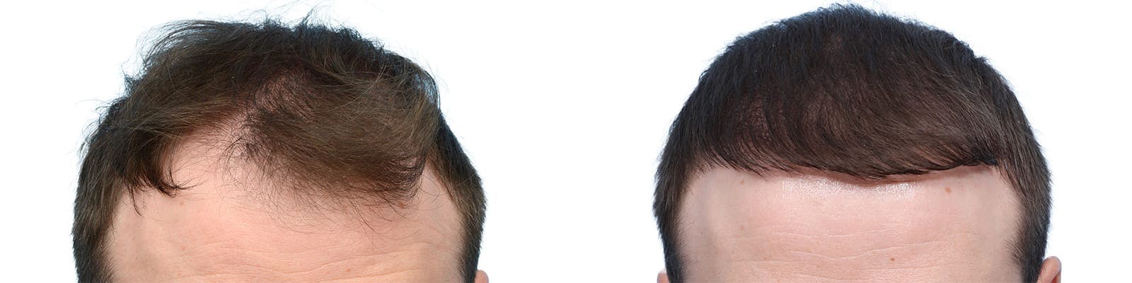 Hair Restoration  Before & After Gallery - Patient 376153 - Image 1