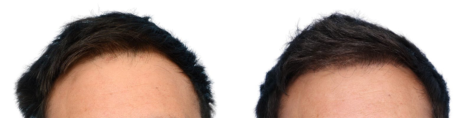 Hair Restoration  Before & After Gallery - Patient 346681 - Image 1