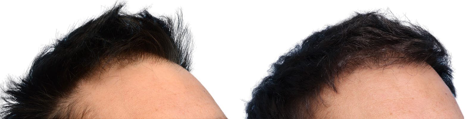 Hair Restoration  Before & After Gallery - Patient 346681 - Image 2