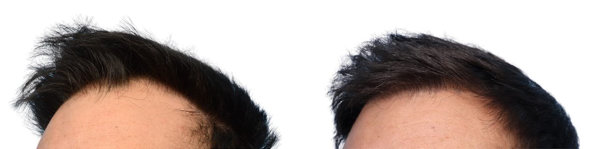 Hair Restoration Before & After Gallery - Patient 346681 - Image 3