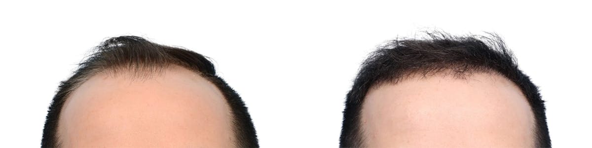 FUE Hair Transplant Before & After Gallery - Patient 427638 - Image 1