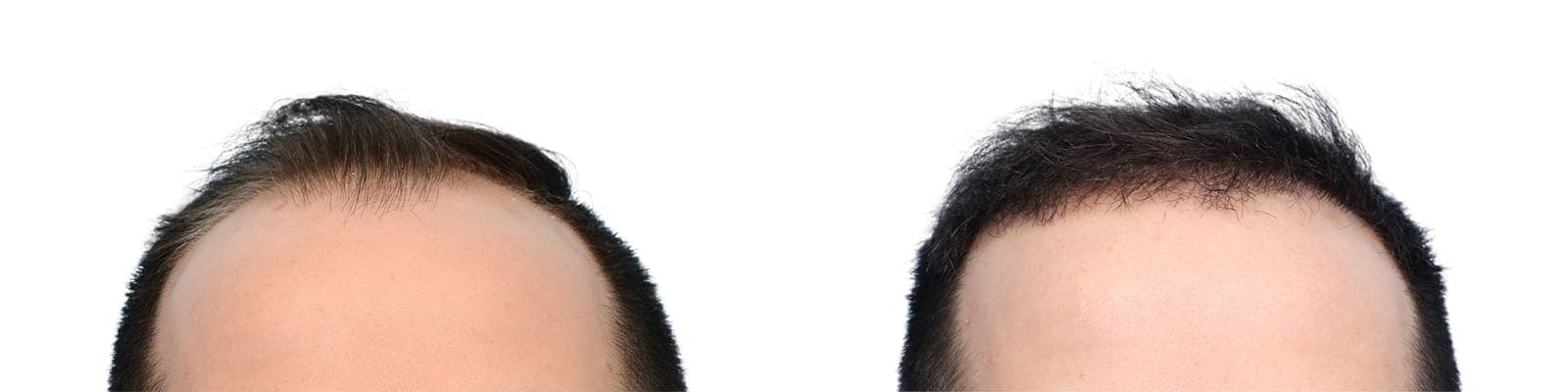 Hair Restoration  Before & After Gallery - Patient 165890 - Image 1