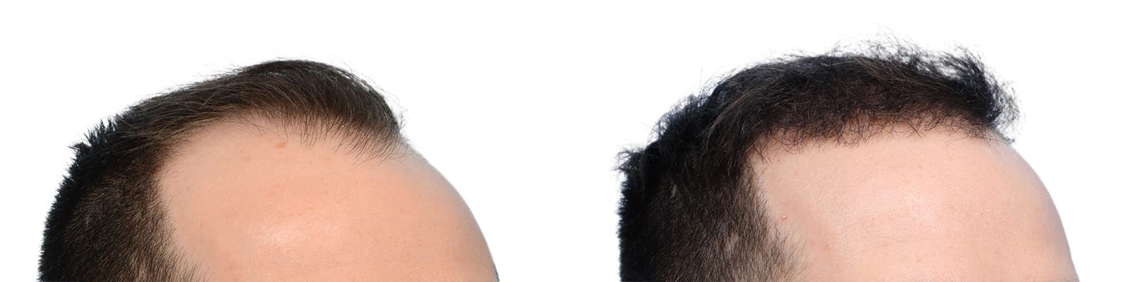 Hair Restoration  Before & After Gallery - Patient 165890 - Image 2