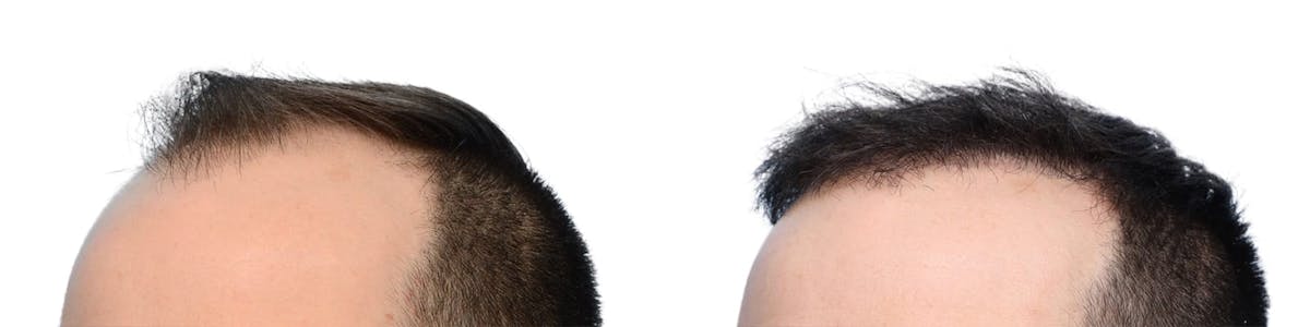 Hair Restoration Before & After Gallery - Patient 165890 - Image 3
