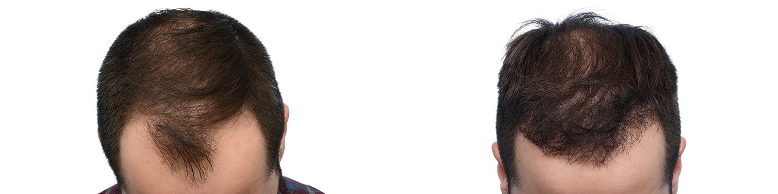 Hair Restoration  Before & After Gallery - Patient 165890 - Image 4