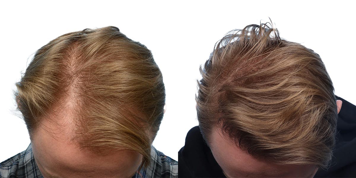 Hair Restoration Before & After Gallery - Patient 350906 - Image 1