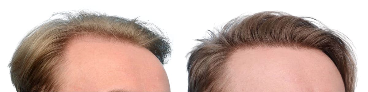 FUE Hair Transplant Before & After Gallery - Patient 392009 - Image 2