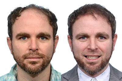 Hair Restoration Before & After Gallery - Patient 319911 - Image 1