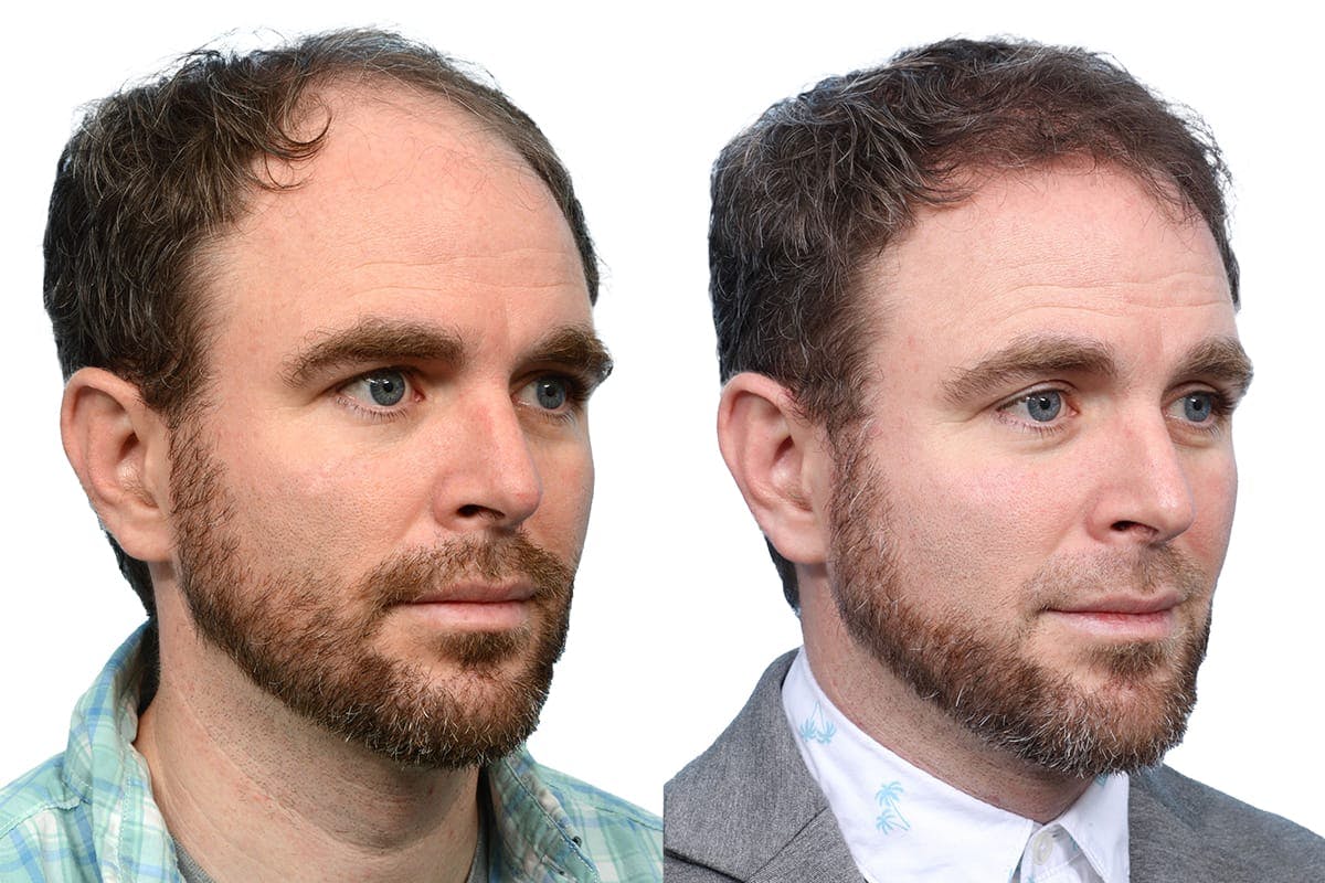 FUE Hair Transplant Before & After Gallery - Patient 760644 - Image 2