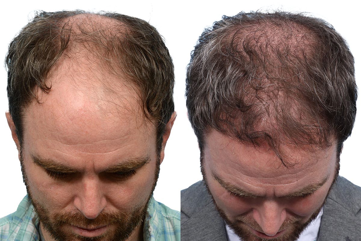 FUE Hair Transplant Before & After Gallery - Patient 760644 - Image 3