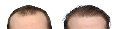 FUE Hair Transplant Before & After Gallery - Patient 169173 - Image 1