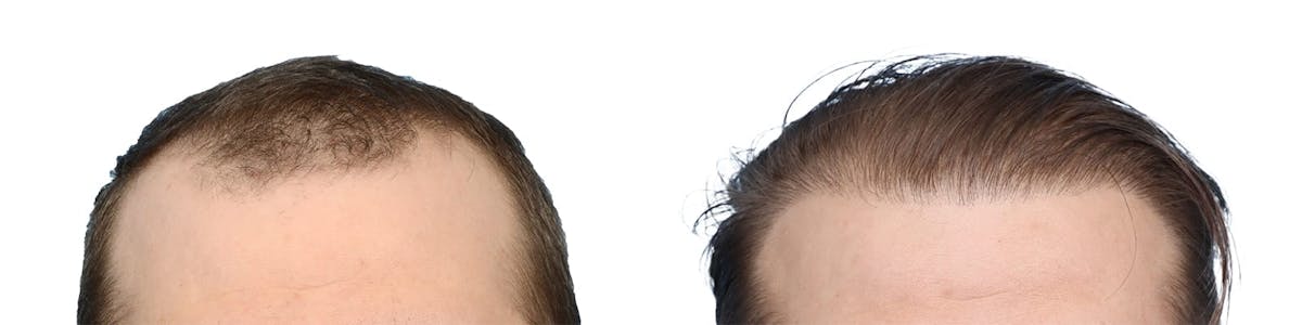 FUE Hair Transplant Before & After Gallery - Patient 169173 - Image 1