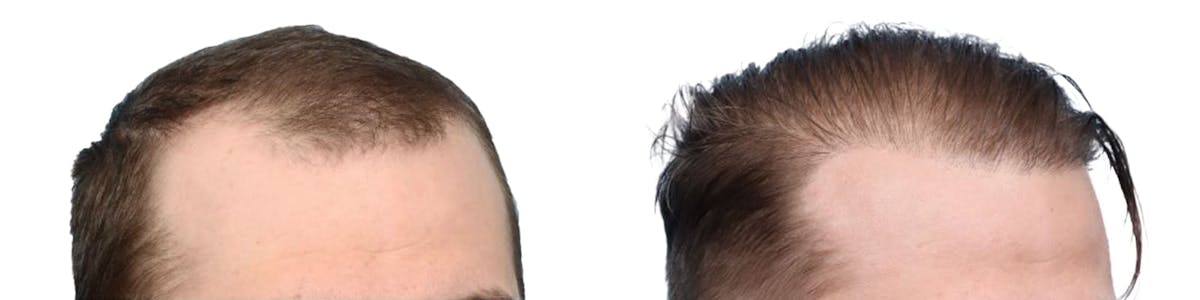 Hair Restoration Before & After Gallery - Patient 224884 - Image 2