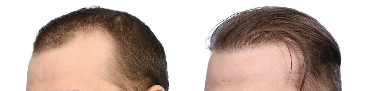 Hair Restoration Before & After Gallery - Patient 224884 - Image 3