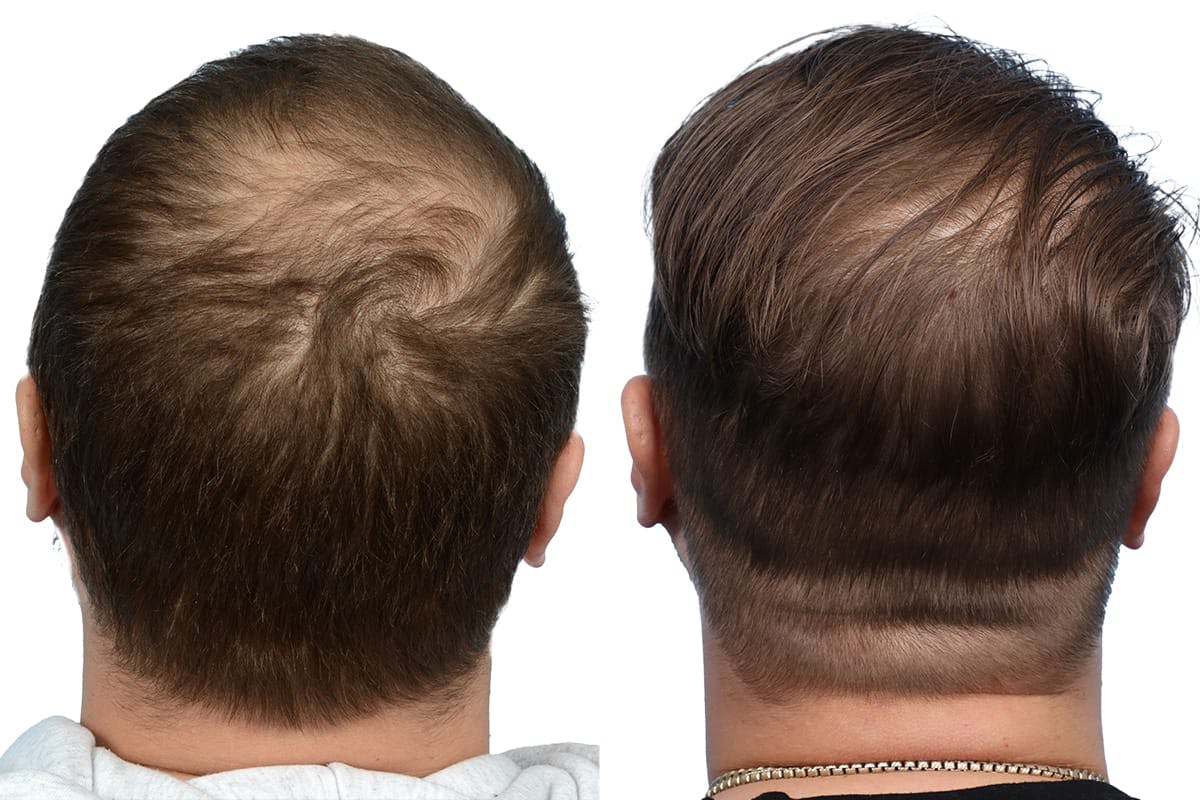 Hair Restoration Before & After Gallery - Patient 224884 - Image 4
