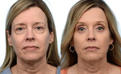 Blepharoplasty (Eyelid Surgery) Before & After Gallery - Patient 186603 - Image 1