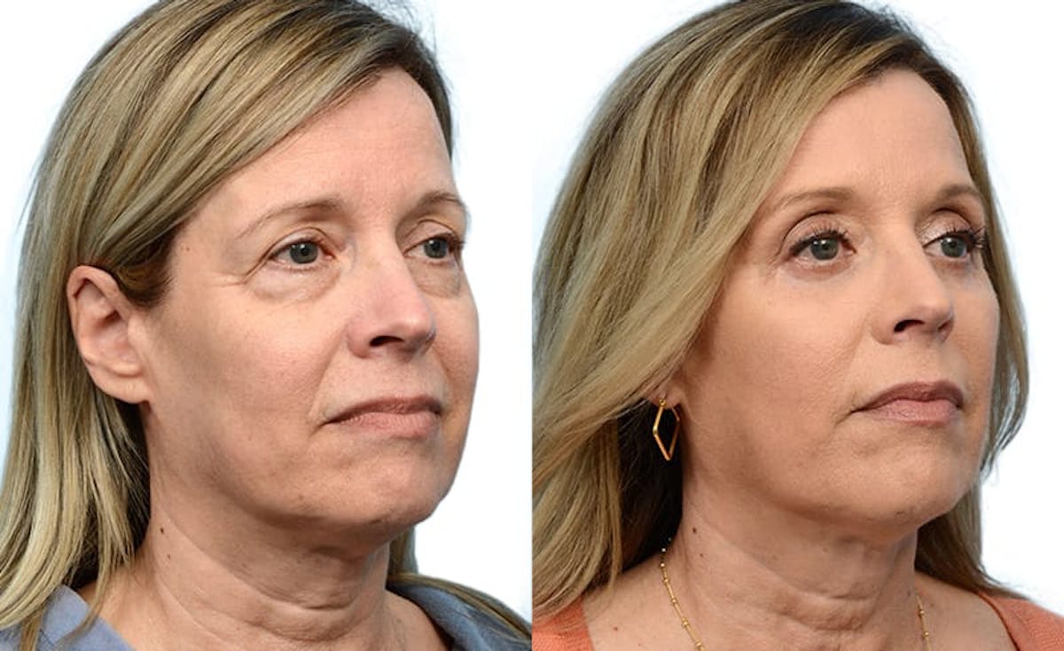 Blepharoplasty (Eyelid Surgery) Before & After Gallery - Patient 186603 - Image 2