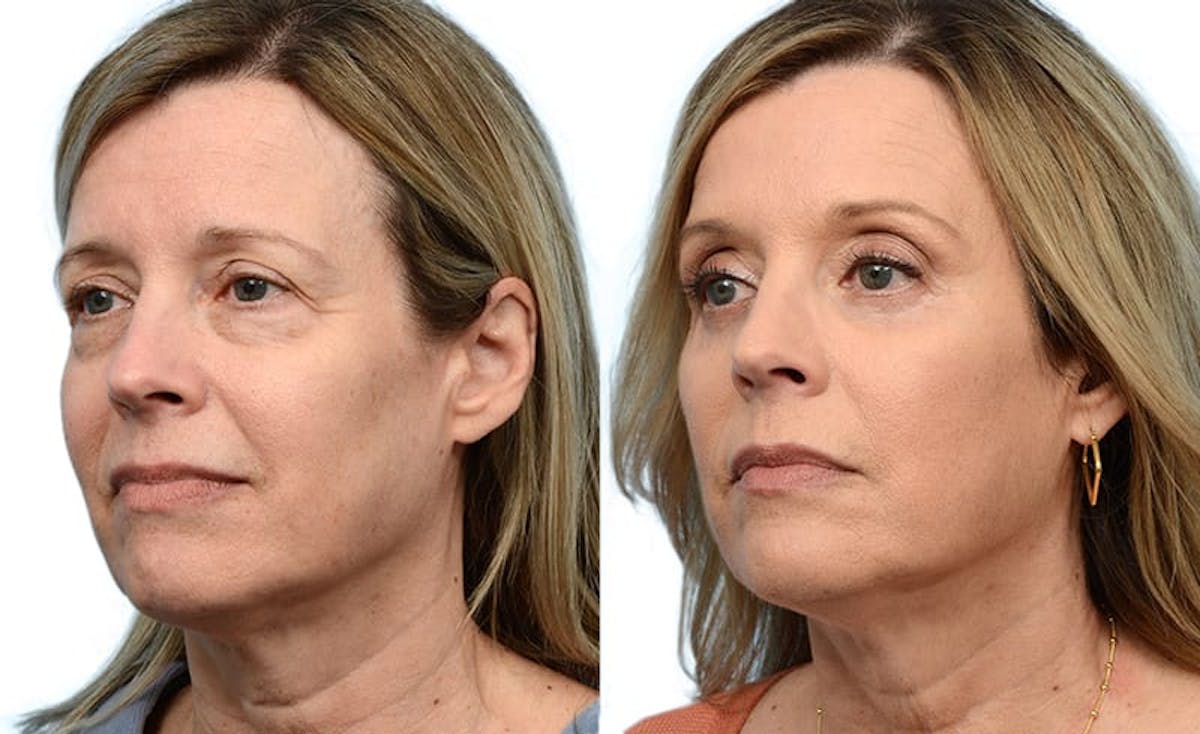 Blepharoplasty (Eyelid Surgery) Before & After Gallery - Patient 186603 - Image 3