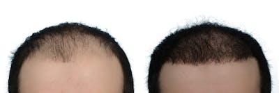 FUE Hair Transplant Before & After Gallery - Patient 101802 - Image 1