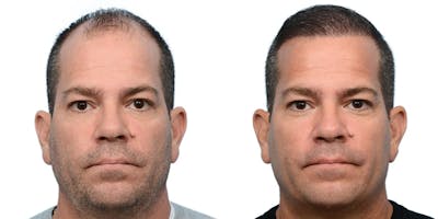 FUE Hair Transplant Before & After Gallery - Patient 781081 - Image 1