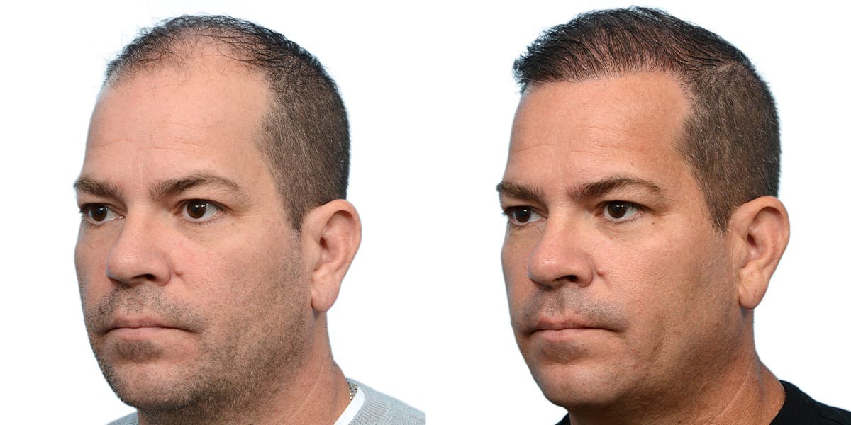 Hair Restoration Before & After Gallery - Patient 290208 - Image 2