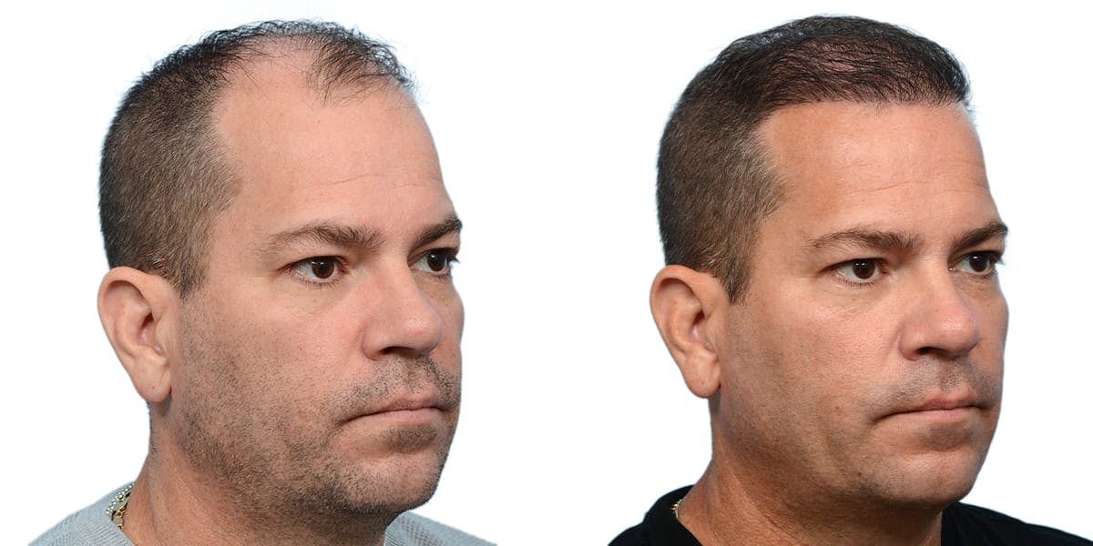 FUE Hair Transplant Before & After Gallery - Patient 781081 - Image 3