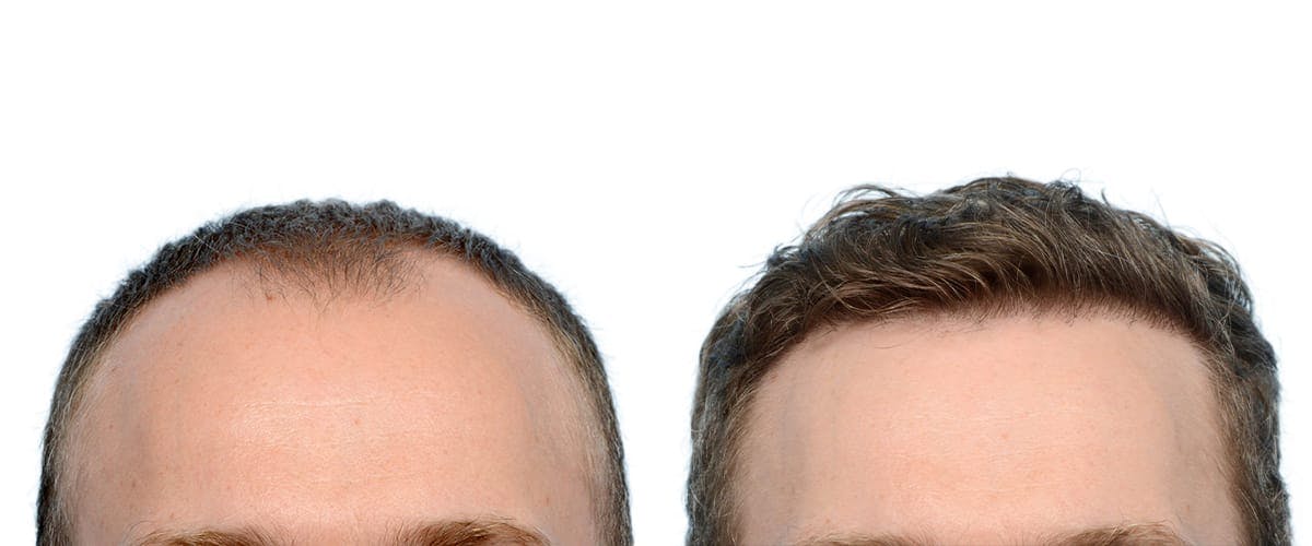 Hair Restoration Before & After Gallery - Patient 387078 - Image 1