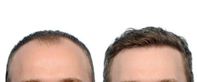 Hair Restoration Before & After Gallery - Patient 387078 - Image 1