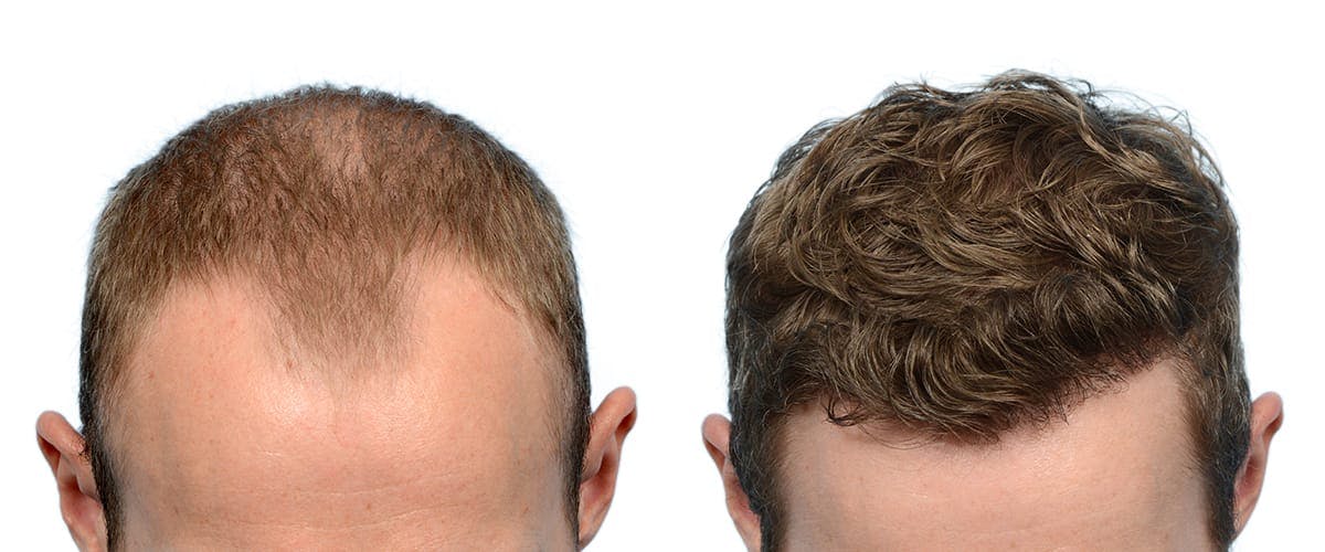 Hair Restoration Before & After Gallery - Patient 387078 - Image 2