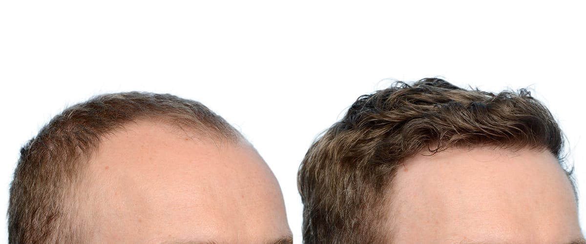 Hair Restoration Before & After Gallery - Patient 387078 - Image 3