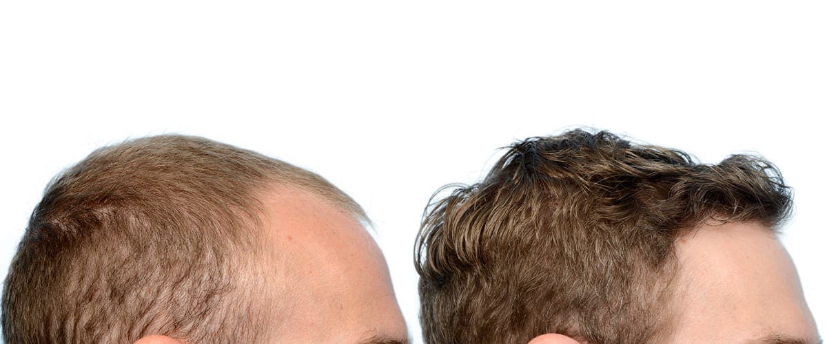 FUE Hair Transplant Before & After Gallery - Patient 166050 - Image 4