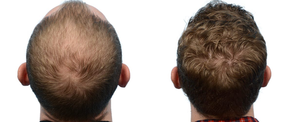 Hair Restoration Before & After Gallery - Patient 387078 - Image 5