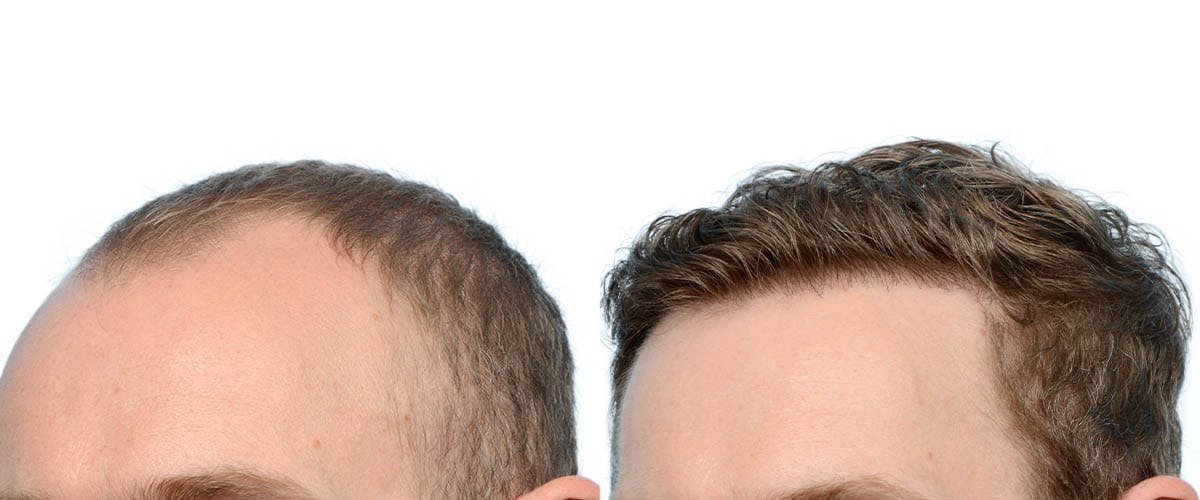 FUE Hair Transplant Before & After Gallery - Patient 166050 - Image 6