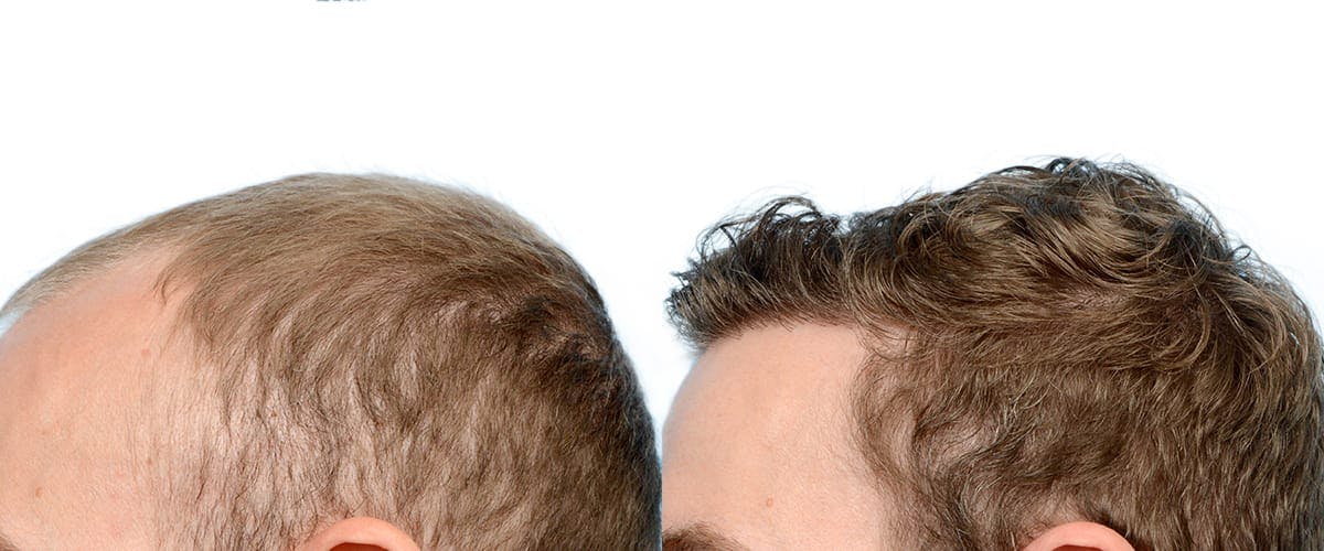 Hair Restoration Before & After Gallery - Patient 387078 - Image 7