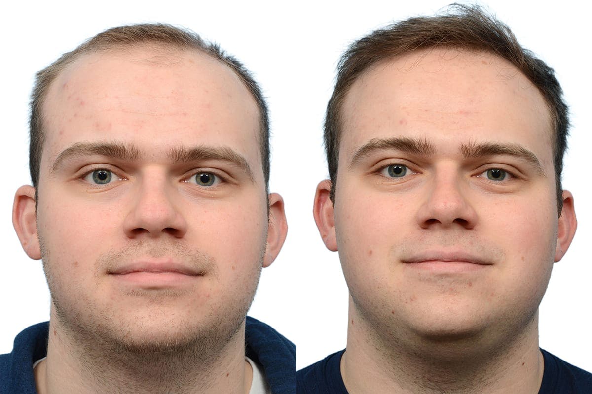 Hair Restoration Before & After Gallery - Patient 358990 - Image 1