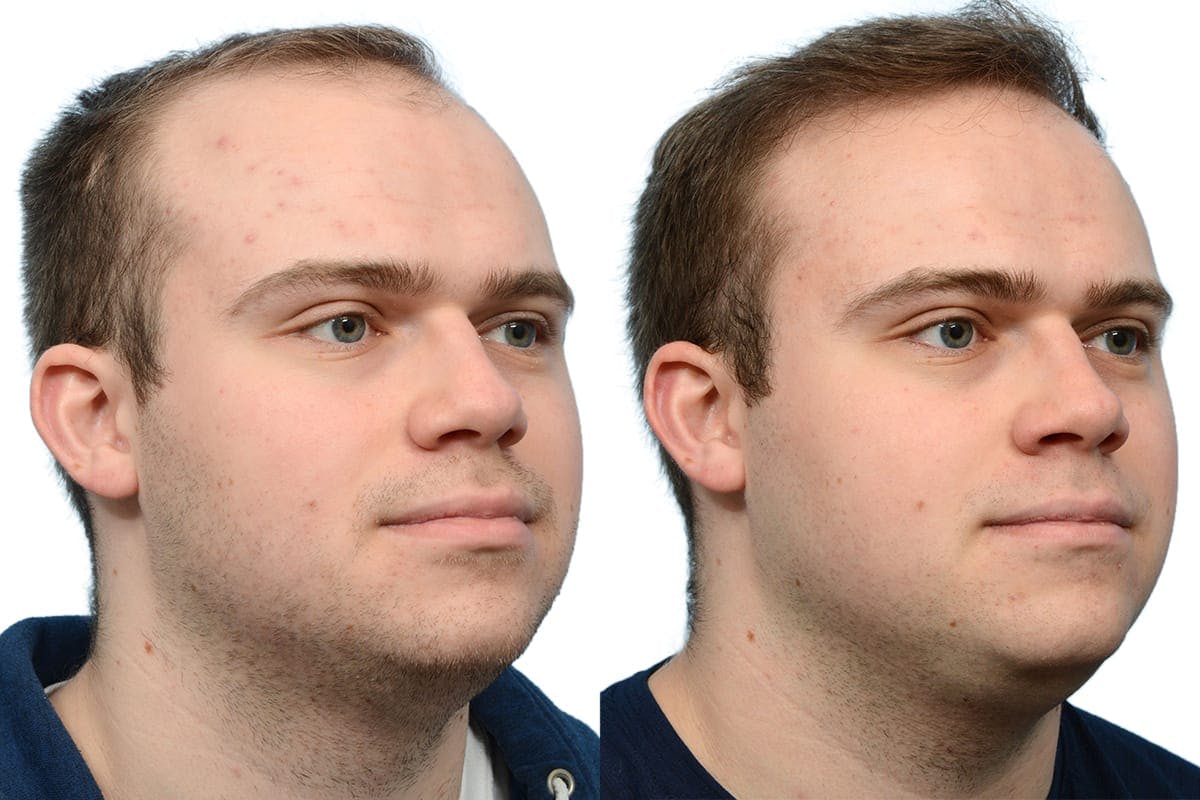 Hair Restoration Before & After Gallery - Patient 358990 - Image 2