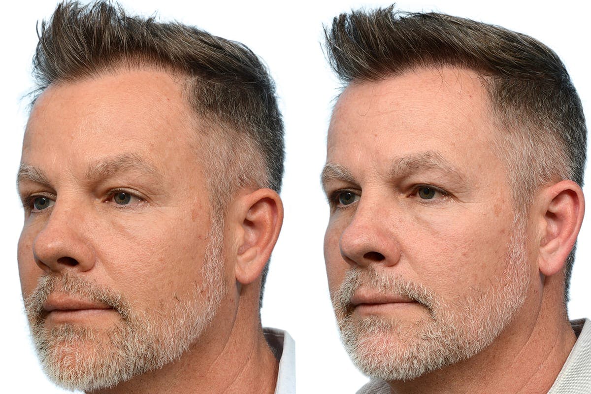 FUE Hair Transplant Before & After Gallery - Patient 292531 - Image 3
