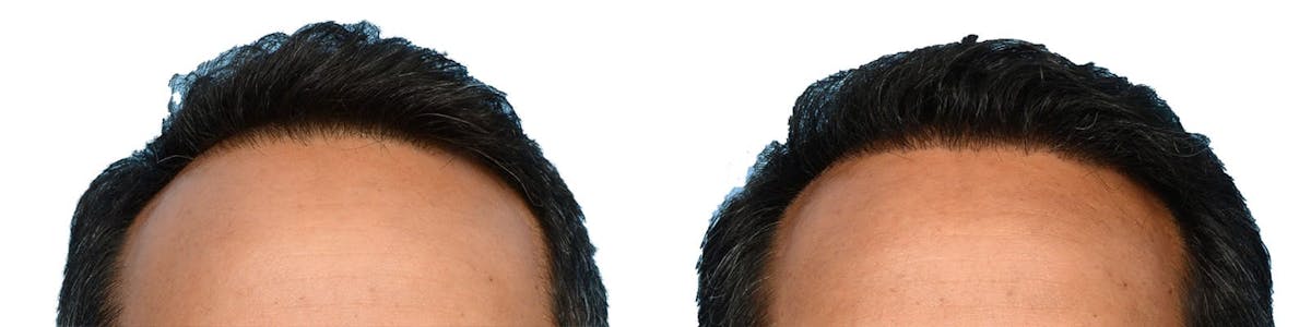 FUE Hair Transplant Before & After Gallery - Patient 315827 - Image 1