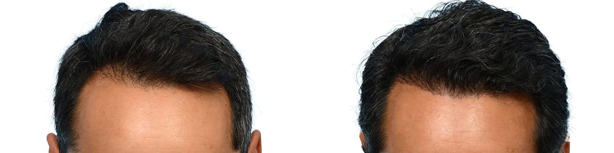 Hair Restoration Before & After Gallery - Patient 421242 - Image 2