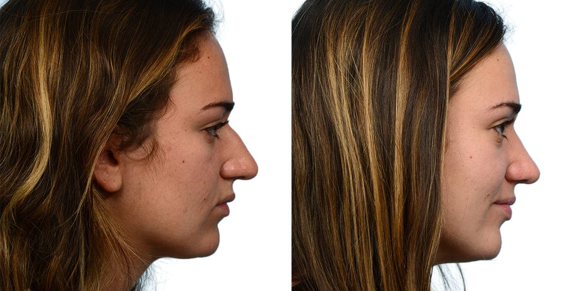 Rhinoplasty Before & After Gallery - Patient 134052 - Image 1
