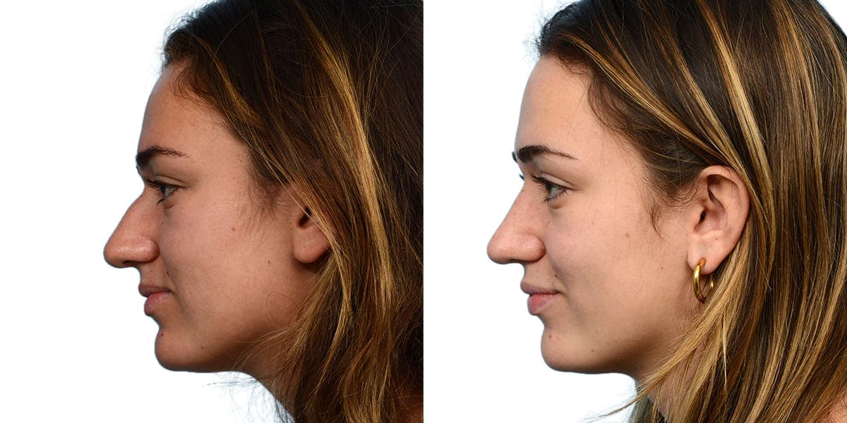 Rhinoplasty Before & After Gallery - Patient 134052 - Image 2