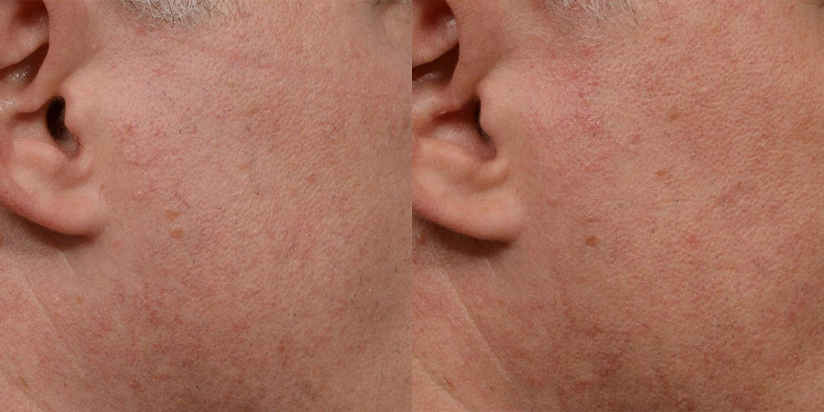 VBeam® Before & After Gallery - Patient 172339 - Image 1