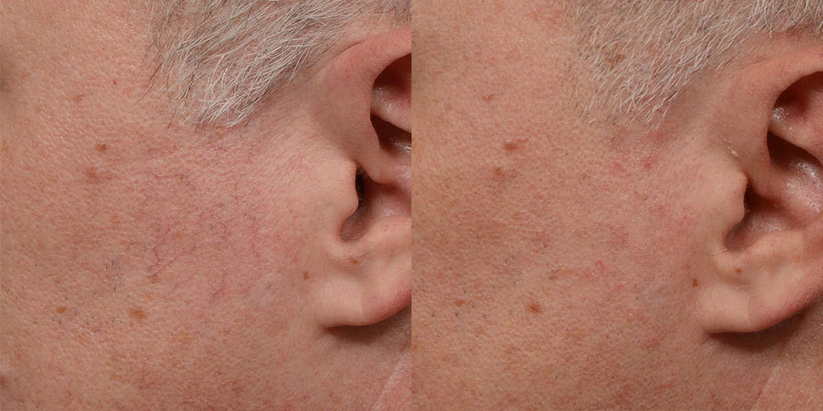 VBeam® Before & After Gallery - Patient 172339 - Image 2